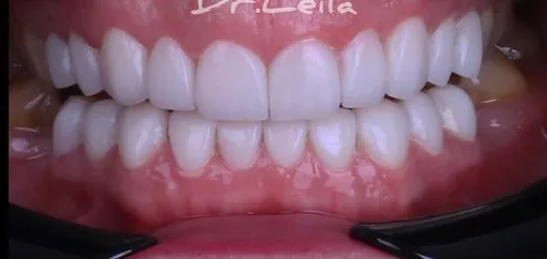 After: Gaps closed, smile line aligned