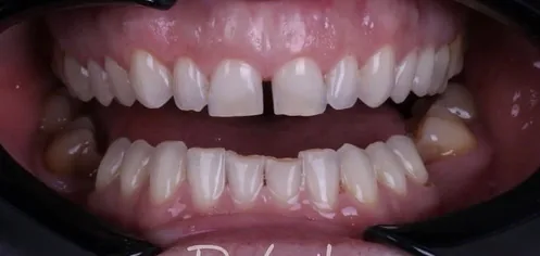 Before: Gaps closed, smile line aligned