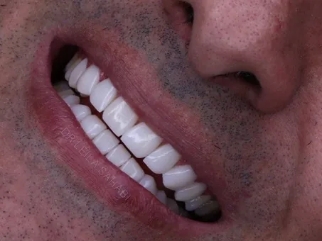 After: Complete smile renewal