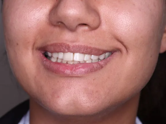 Before: A softer, brighter smile