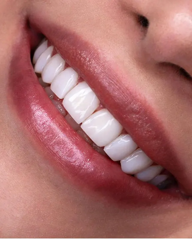 Smile result by Dr. Leila Sahabi, cosmetic dentist in Dubai