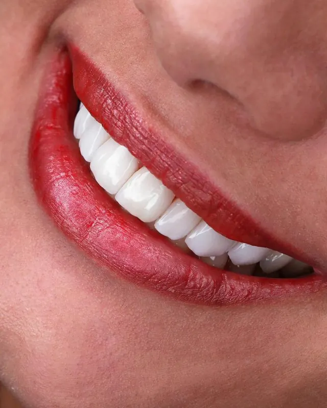 Smile result by Dr. Leila Sahabi, cosmetic dentist in Dubai