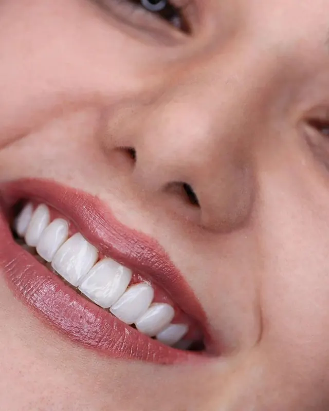 Smile result by Dr. Leila Sahabi, cosmetic dentist in Dubai