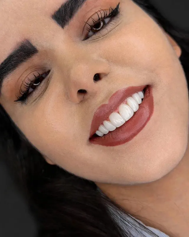 Smile result by Dr. Leila Sahabi, cosmetic dentist in Dubai