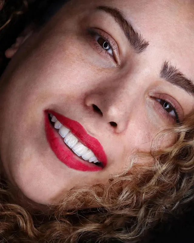 Smile result by Dr. Leila Sahabi, cosmetic dentist in Dubai