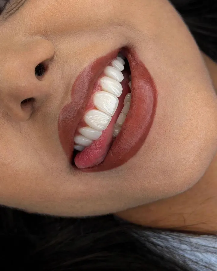 Composite veneers and bonding in Dubai