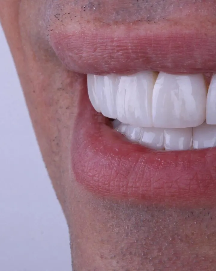 Porcelain veneers in Dubai
